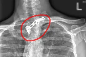 小伙锁骨打钢板13年没取出，13年后钢板突然“咔”的一声断在体内……图片