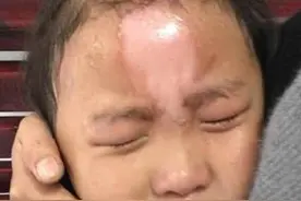 6岁孙女掉入“开水锅”，姥姥“教科书般”处理方式，让医生大赞图片