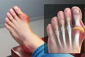 痛风吃非布司他有哪些副作用？长期服药，医生很想让你知道3件事图片