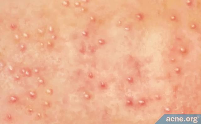 屁股上的毛周角化怎么去除 屁股上的毛周角化怎么去除