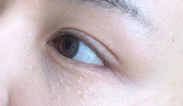 脸部小油脂粒