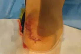 南昌：5岁女孩摔伤缝了20多针，赔偿时游乐场质疑有“过度医疗”图片