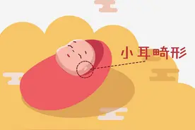 【科普系列】耳模矫正技术—帮助先天性耳廓形态畸形患儿重塑完美耳朵图片