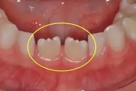 6-12岁换牙时间和换牙期问题大盘点！孩子一口好牙关键就在这几点图片