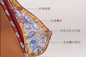 丨康复馆丨针灸治疗乳腺增生症图片