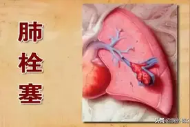 女子长期口服避孕药致肺栓塞，是怎么回事？肺栓塞有什么表现？图片