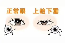 睡眼惺忪的你是不是早已患上了上睑下垂？图片