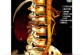 腹主动脉（CTA）三维血管解剖--精品图集图片