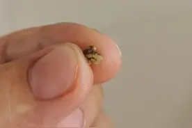 昨天终于把我肾里的舍利子（肾结石）排出来了，我的排石经历图片