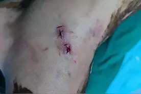 广西一男子楼下抽烟被竹叶青咬伤，有多毒？比五步蛇还强20倍图片