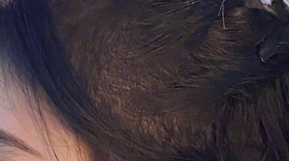 耳朵前鬓角下鸡皮疙瘩红印