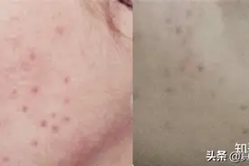 去痘印产品终极盘点，这几款效果肉眼可见！网友：价格效果成正比图片