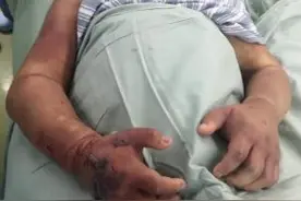 儿童骨科急诊—骨筋膜室综合征图片