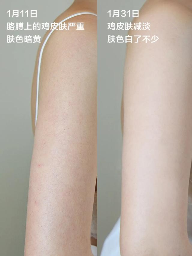 用了身体乳身体长红色痘痘