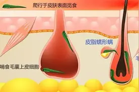 眼睛干痒治不好，原来是眼部生长的螨虫闹的图片