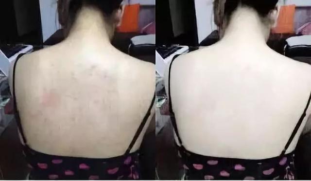 鸡皮肤治疗神器