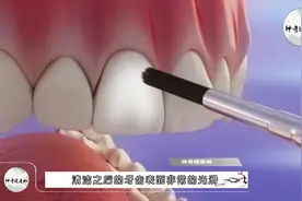 矫正牙齿的牙套是如何安装的？3D模拟复原全程，看完莫名牙疼！视频封面