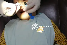 孩子乳磨牙被蛀，必须要补了，乳磨牙要到10岁以后才换牙……视频封面
