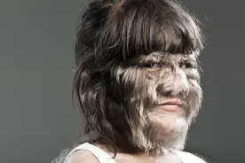满脸长毛的狼人女孩，剃毛之后长这样，之后找到真爱视频封面