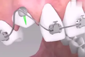 知道金属牙箍矫正牙齿的原理吗？这个视频或许对你有帮助。视频封面