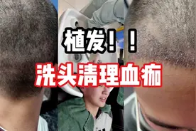 植发术后七天清理血痂！！！