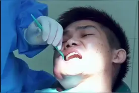 智齿反复发炎不拔 脸部化脓烂穿视频封面