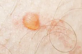 生殖器疱疹挂什么科室？听了医生讲解，不会跑错科室视频封面