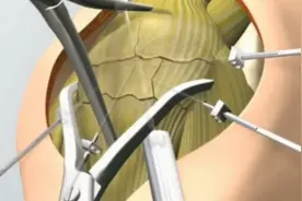 3D动画髌骨骨折手术视频，了解修复过程，很多运动朋友多注意哦