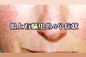 脸上布满螨虫的4个症状