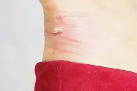 生活窍门：后脚跟总是被磨出水泡，试试这招，大家都说好！