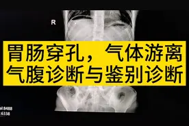 腹部剧烈疼痛，胃肠道穿孔破裂，腹部平片入门级诊断