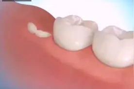 医学3D动画演示：原来智齿是这样拔掉的