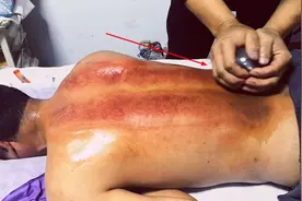 郑大拿操作实例：走罐的基本操作步骤，舒筋活血，清热去火视频封面