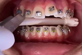 你还在怕戴牙套？来看看矫正的全过程吧！