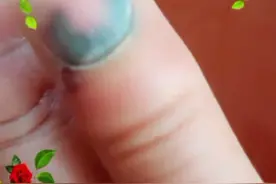 指甲砸黑了咋办视频封面