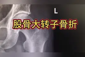 不小心摔伤，大胯疼痛，拍了平片找到了原因，股骨大转子骨折！