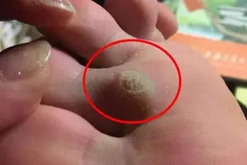 别再为去鸡眼烦恼了，教你一个技巧，不受罪不受痛，自动跑出来视频封面
