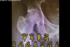 北京航空总医院关节外科股骨头坏死治疗团队为您的股骨头护航视频封面