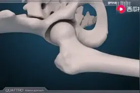 3D动画演示置换人工股骨头视频封面