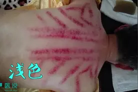 刮痧后出现的不同痧痕颜色说明了什么？
