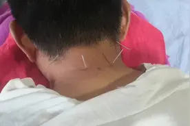 医生演示一例颈椎病的针灸治疗。