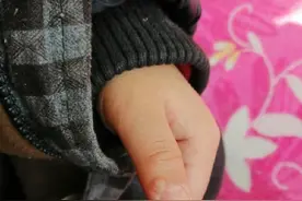 跖疣刺猴鸡眼修复视频封面