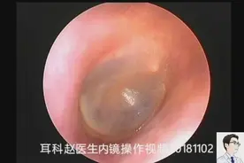 耳内镜清理外耳道的霉菌和干燥耵聍块，12分钟