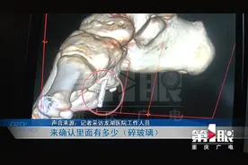 手术后疼痛一个月 脚掌玻璃碎片没取出视频封面