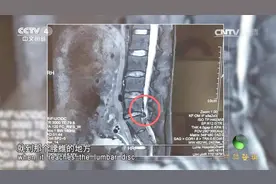 孕妇腰椎间盘突出疼痛难忍，医生是怎么解决这个问题的呢？来看看视频封面