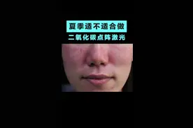 夏天到了，可以做#二氧化碳点阵激光 吗？#皮肤管理 #健康科普视频封面