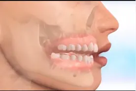 虎牙难看怎么办？看看隐形牙套是如何矫正虎牙的吧？视频封面