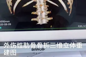 外伤性肋骨骨折三维图视频封面