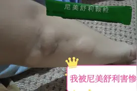 尼美舒利颗粒慎用!，退烧是退了，但身体大片过敏奇痒肿无法入睡视频封面