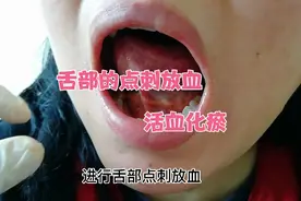 舌下静脉又粗又黑，提示血液循环不好，可以点刺放血：保健之道视频封面